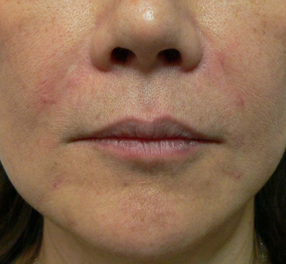 nasolabial smile line midtown manhattan nyc